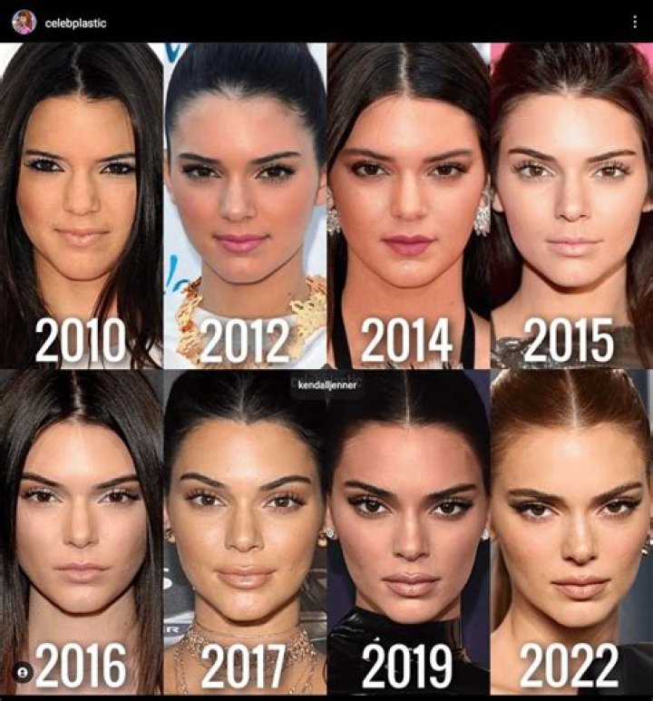 The Truth About Kylie Jenner Lip Challenge: Risks And Remedies Revealed