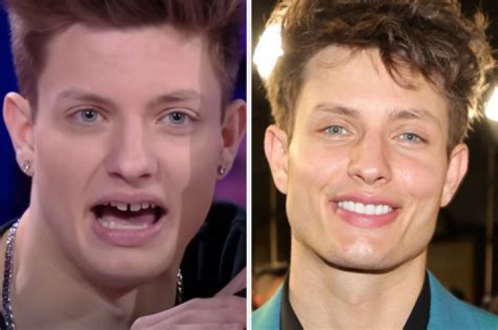 Unveiling Matt Rife's Dental Transformation: A Journey Of Smiles